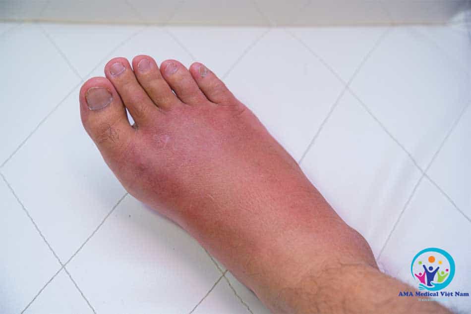 Thepharm dùng để trị phù nề do viêm, sau chấn thương hoặc sau phẫu thuật